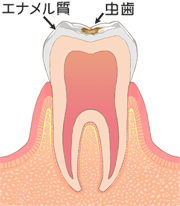 C1:歯の表層(エナメル質)の虫歯