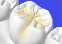 インレー(詰め物)